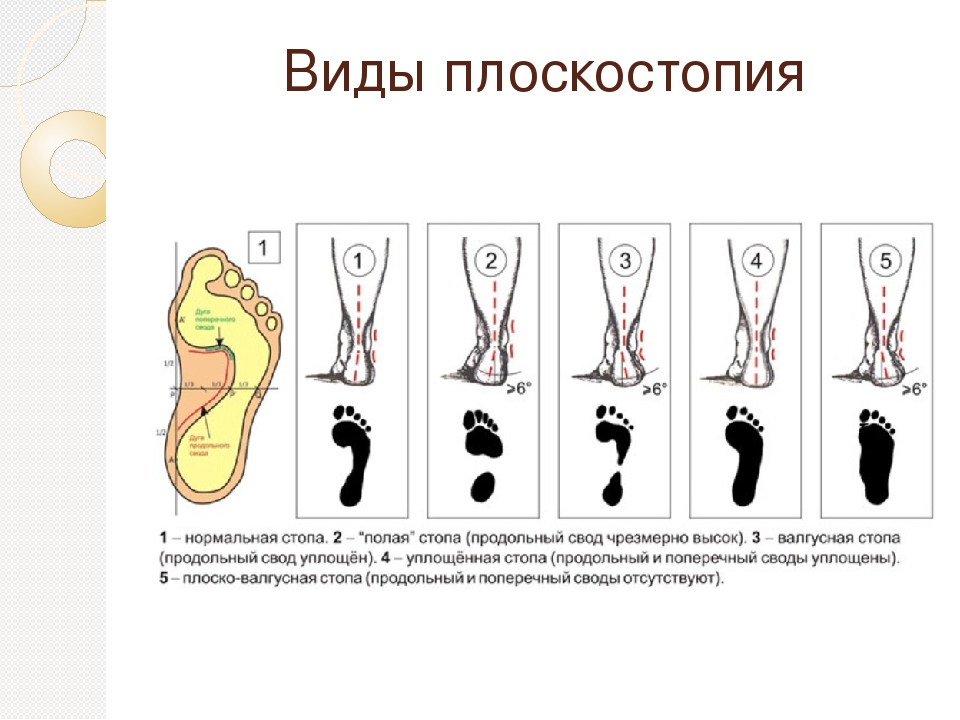 Ортопедические корректирующие стельки