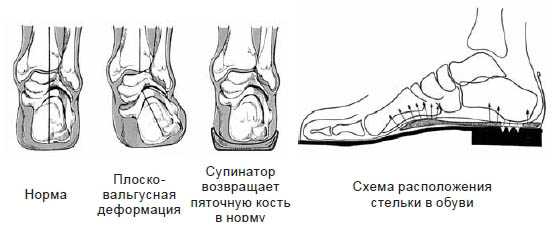 Супинатор в сандалях фото